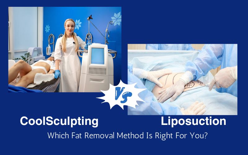 CoolSculpting vs. Liposuction - 3 Difference in the Procedures