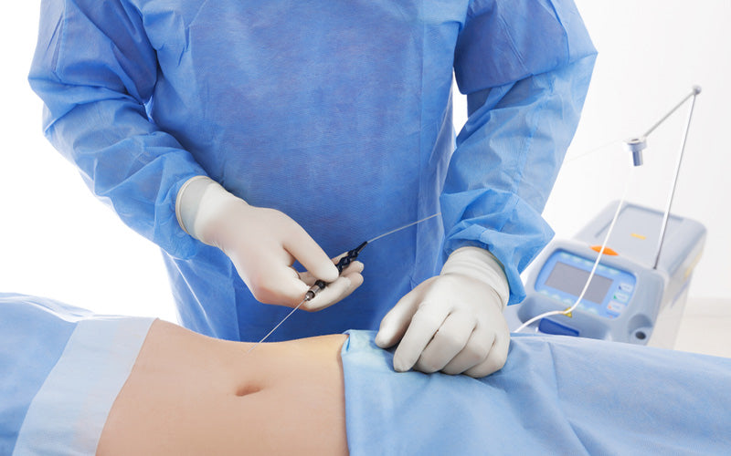 Does Fat Return After Liposuction?