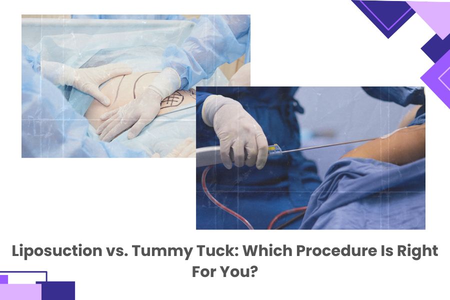 Liposuction vs. Tummy Tuck: Which Procedure Is Right For You?