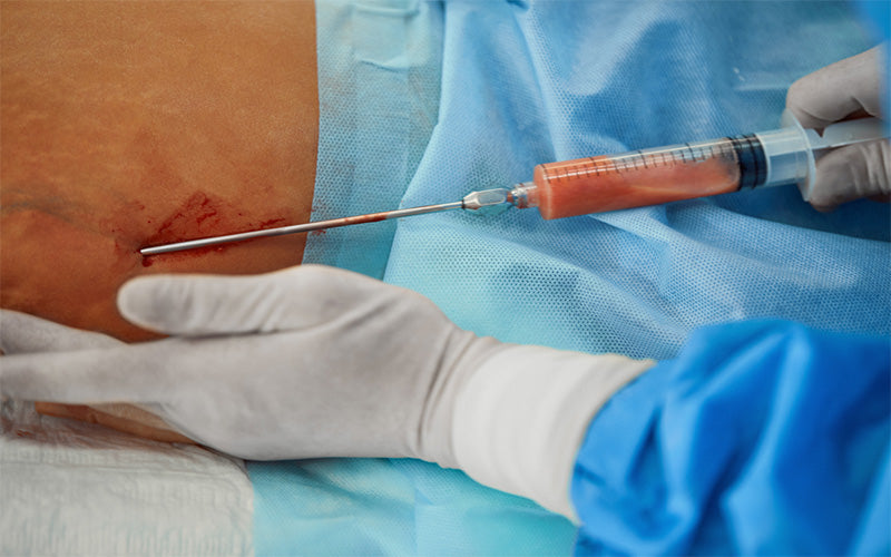 5 years After Liposuction