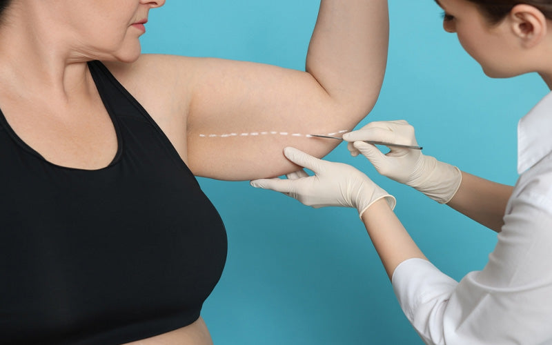 Are Arm Lifts Permanent? 