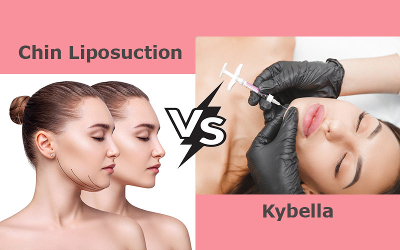 Chin liposuction Vs. Kybella