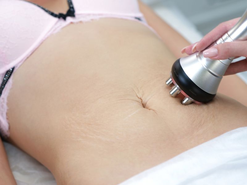 How To Fix Uneven Liposuction: