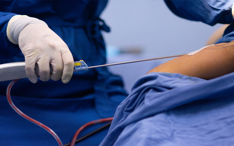 How To Get Rid Of Fluid Pockets After Liposuction: Effective Post-Surgery Techniques