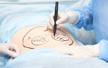 Is Liposuction Safe? 