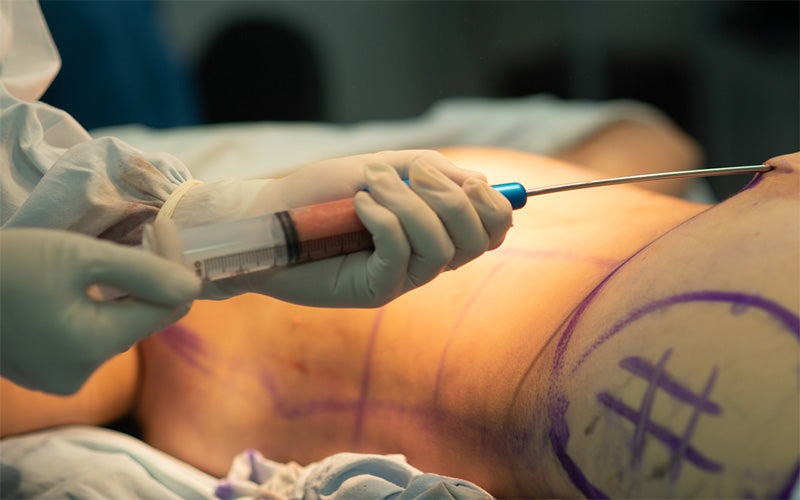 Lipo 360 Recovery Tips: Your Guide To A Smooth Healing Process
