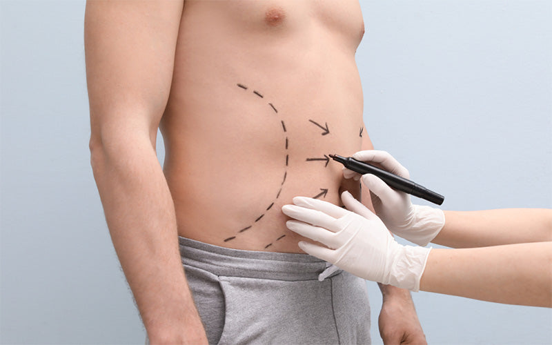 Liposuction Men