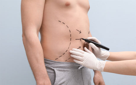 Liposuction Men