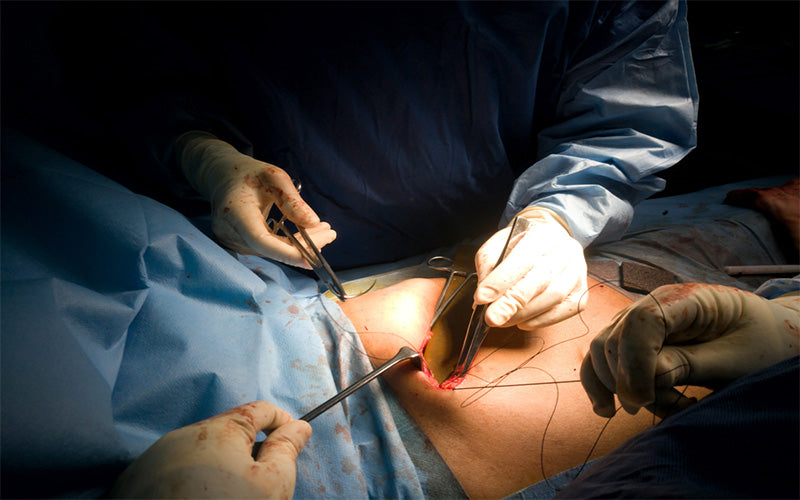  Liposuction Scars: Treatment, Reduction, And Recovery