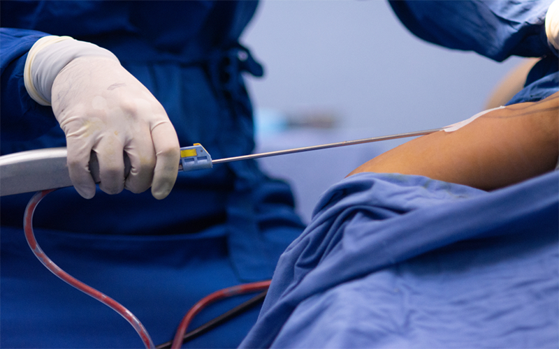 Home Remedies For Nerve Pain after Liposuction