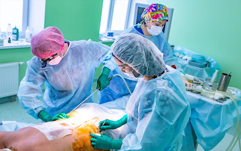 Non-Surgical Liposuction Alternatives