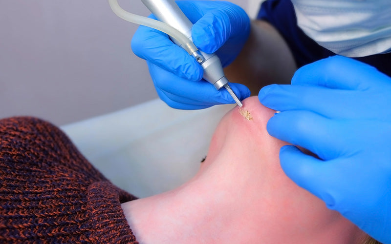 Chin Liposuction Scars