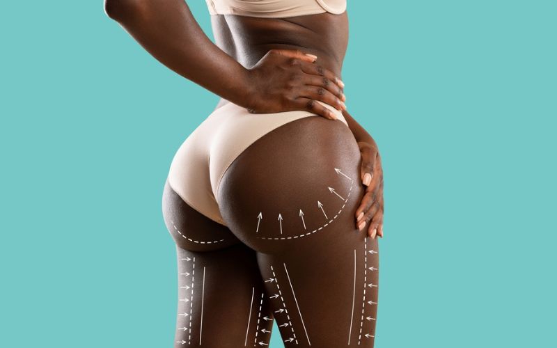 The Essential Dos and Don'ts After BBL Surgery for Optimal Results